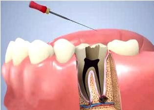 root canal treatment