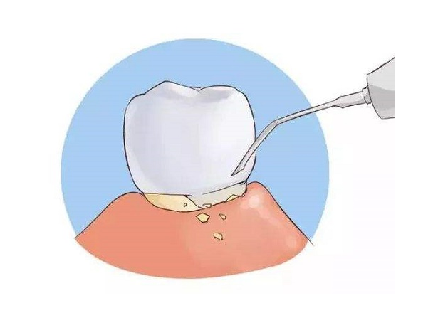 Past and present life of dental calculus