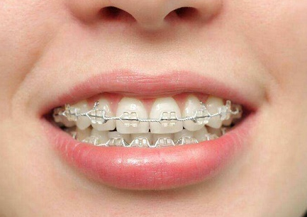 adult orthodontics and children orthodontics