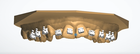 digital positioned braces